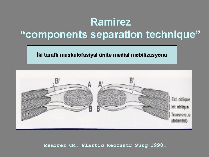 Ramirez “components separation technique” İki taraflı muskulofasiyal ünite medial mobilizasyonu Ramirez OM. Plastic Reconstr