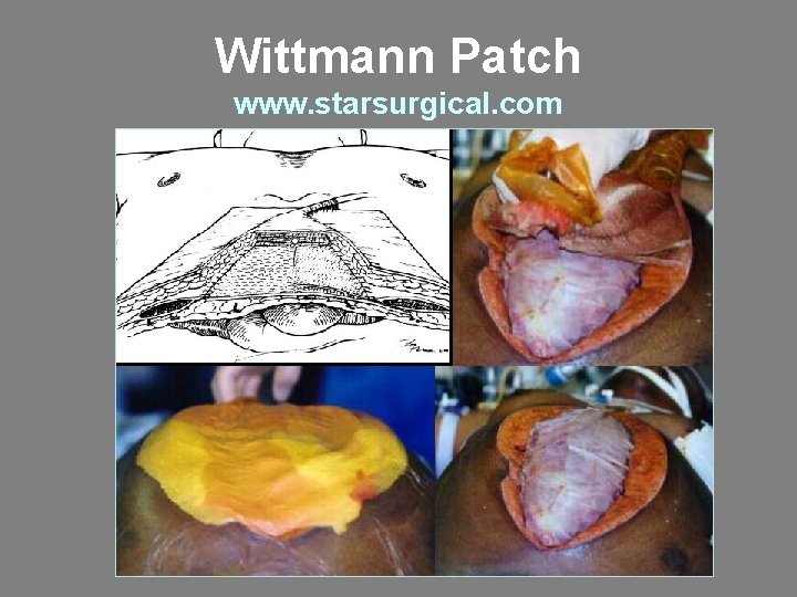 Wittmann Patch www. starsurgical. com 