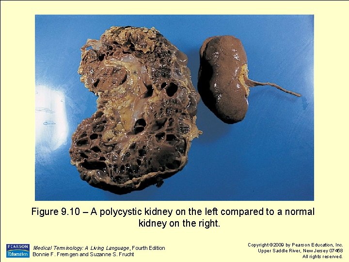 Figure 9. 10 – A polycystic kidney on the left compared to a normal