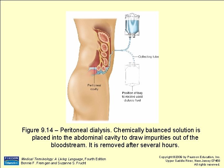 Figure 9. 14 – Peritoneal dialysis. Chemically balanced solution is placed into the abdominal