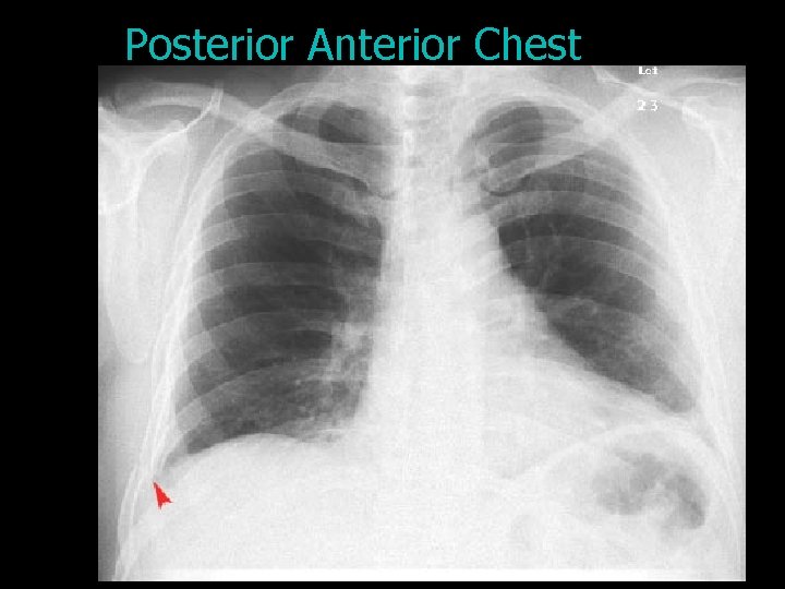 Posterior Anterior Chest 