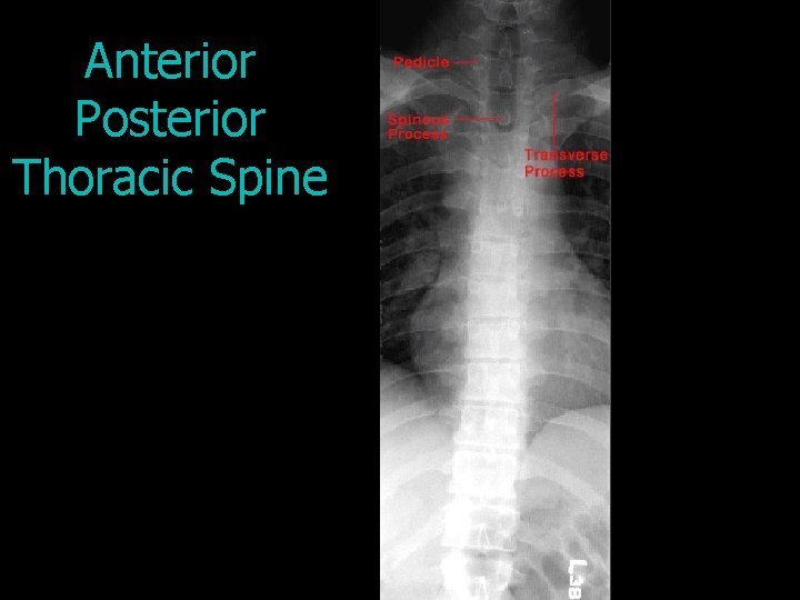 Anterior Posterior Thoracic Spine 