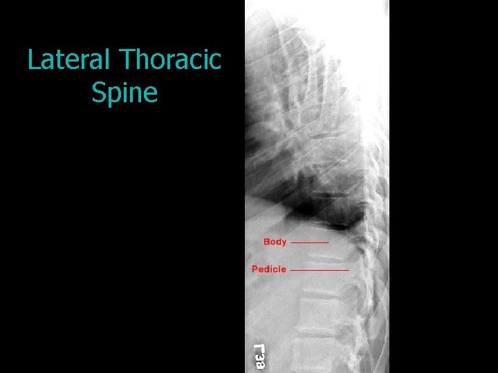 Lateral Thoracic Spine 