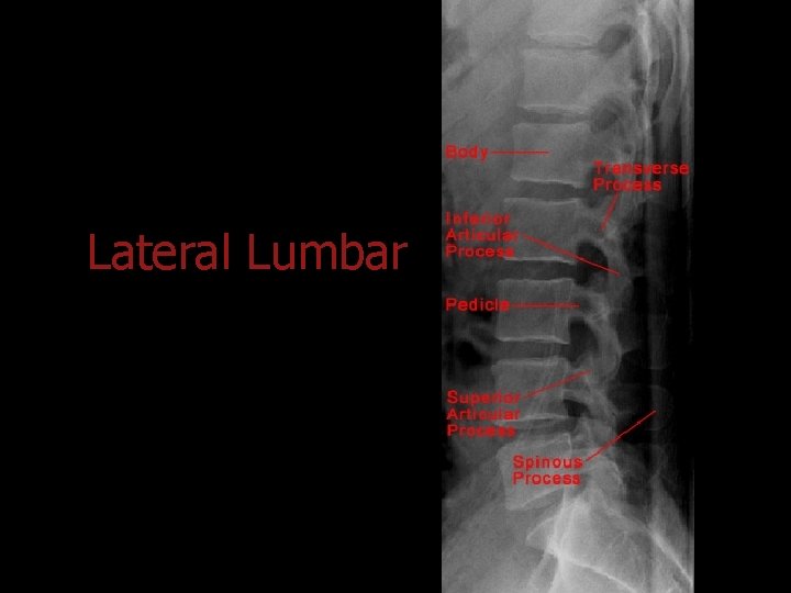 Lateral Lumbar 