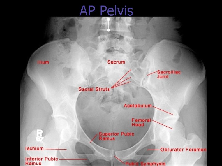 AP Pelvis 