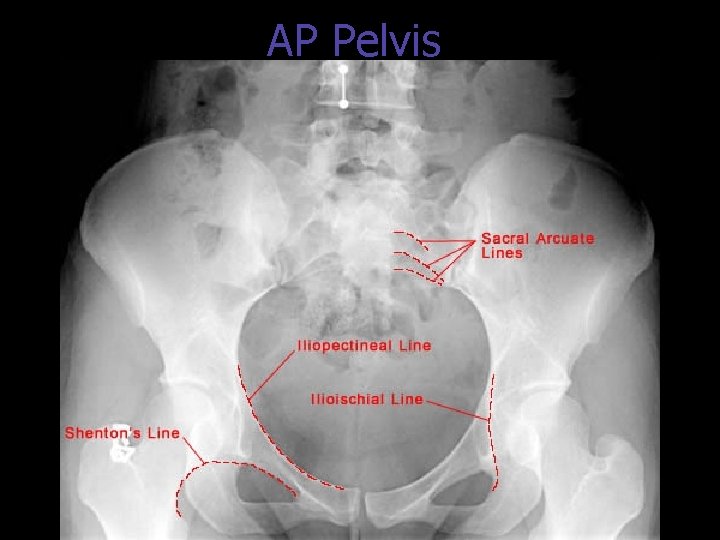 AP Pelvis 