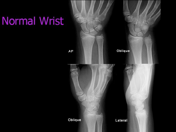 Normal Wrist 