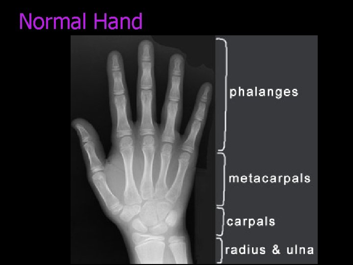 Normal Hand 