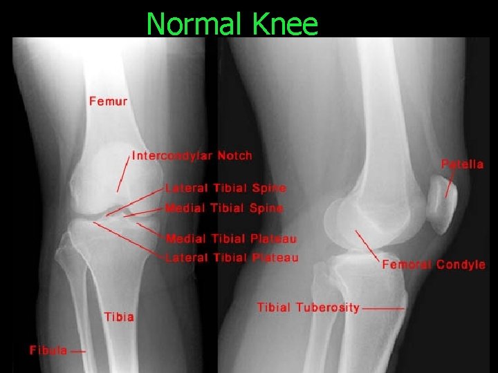 Normal Knee 