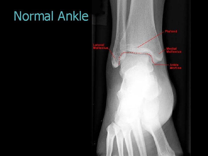 Normal Ankle 