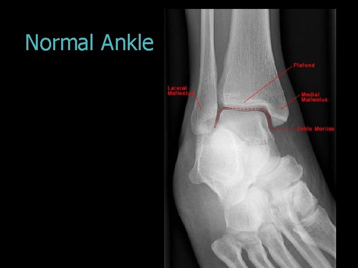 Normal Ankle 