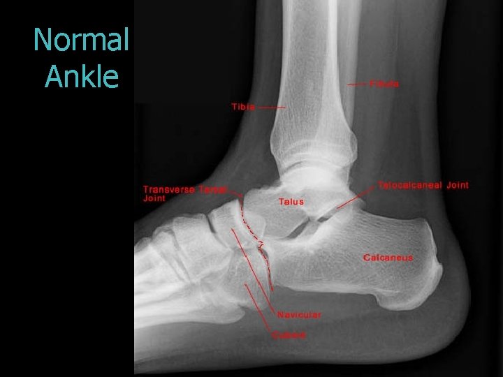 Normal Ankle 