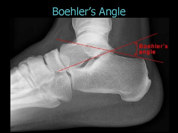 Boehler’s Angle 