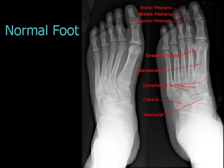 Normal Foot 