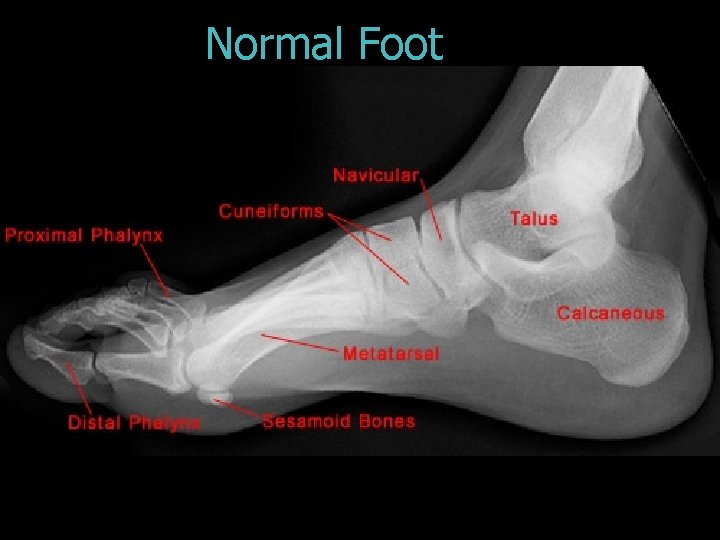 Normal Foot 