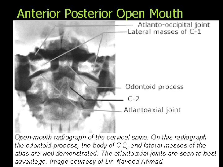 Anterior Posterior Open Mouth 