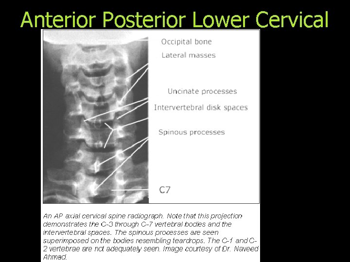 Anterior Posterior Lower Cervical 