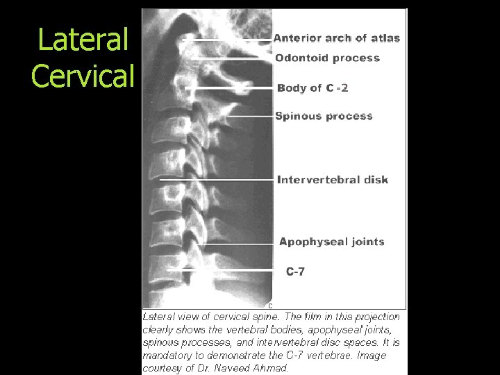 Lateral Cervical 