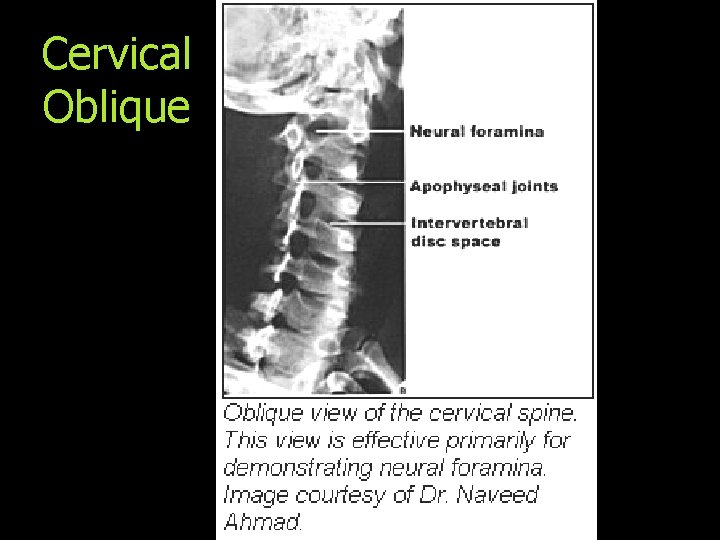 Cervical Oblique 