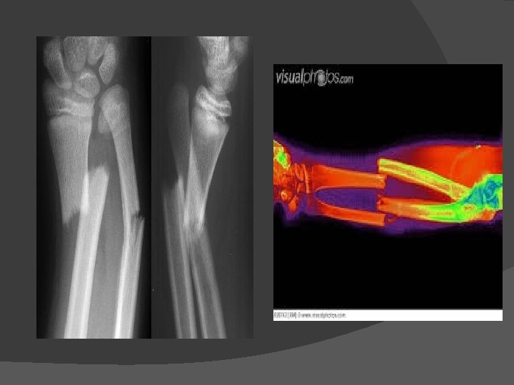 FRACTURES OF THE RADIUS ULNA GROUP 1 MSK