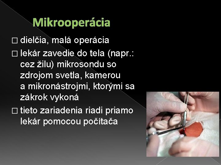 Mikrooperácia � dielčia, malá operácia � lekár zavedie do tela (napr. : cez žilu)