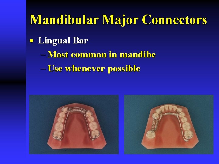 Mandibular Major Connectors · Lingual Bar - Most common in mandibe - Use whenever