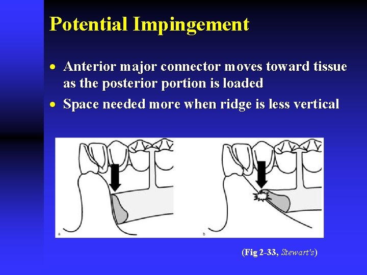 Potential Impingement · Anterior major connector moves toward tissue as the posterior portion is