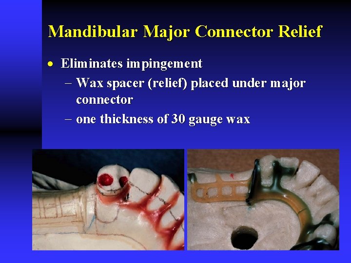 Mandibular Major Connector Relief · Eliminates impingement - Wax spacer (relief) placed under major