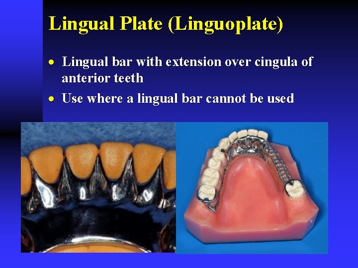 Lingual Plate (Linguoplate) · Lingual bar with extension over cingula of anterior teeth ·