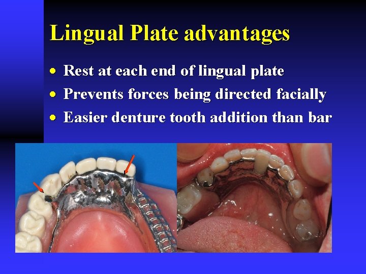 Lingual Plate advantages · Rest at each end of lingual plate · Prevents forces