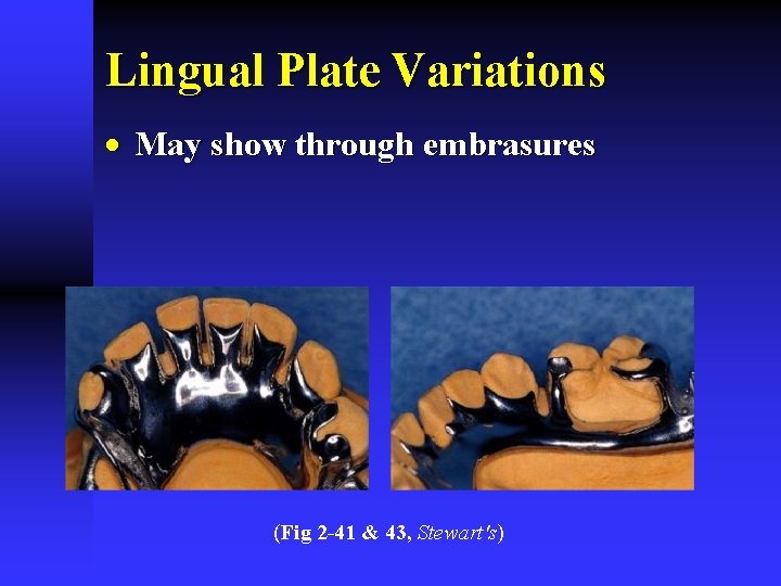 Lingual Plate Variations · May show through embrasures (Fig 2 -41 & 43, Stewart's)