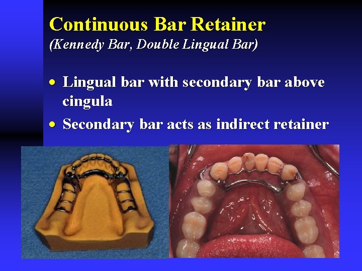 Continuous Bar Retainer (Kennedy Bar, Double Lingual Bar) · Lingual bar with secondary bar