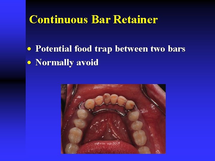 Continuous Bar Retainer · Potential food trap between two bars · Normally avoid 