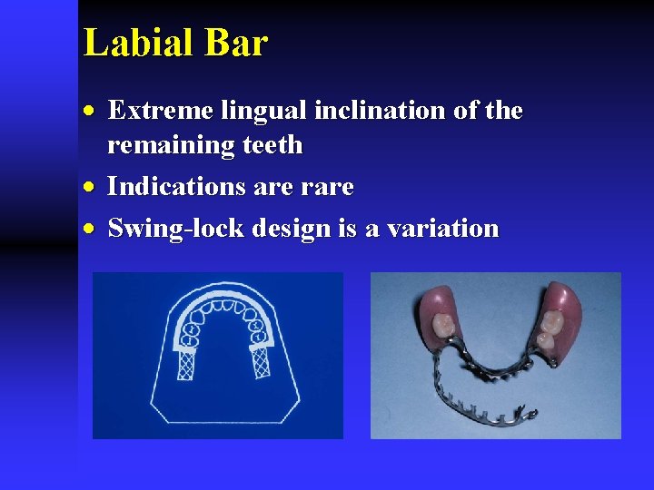 Labial Bar · Extreme lingual inclination of the remaining teeth · Indications are rare