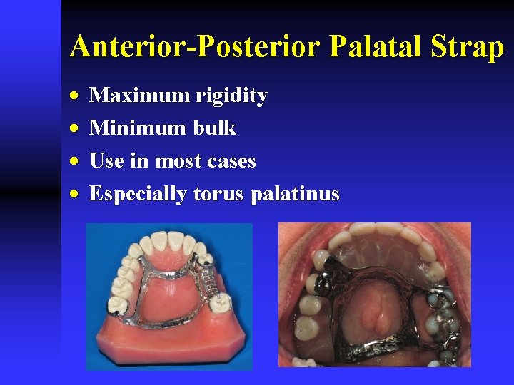 Anterior-Posterior Palatal Strap · · Maximum rigidity Minimum bulk Use in most cases Especially Anterior-Posterior Palatal Strap · · Maximum rigidity Minimum bulk Use in most cases Especially