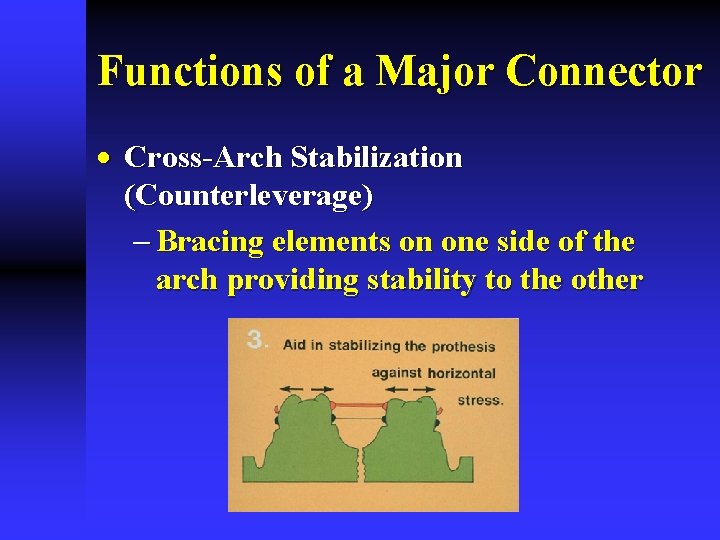 Functions of a Major Connector · Cross-Arch Stabilization (Counterleverage) - Bracing elements on one