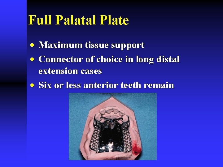 Full Palatal Plate · Maximum tissue support · Connector of choice in long distal