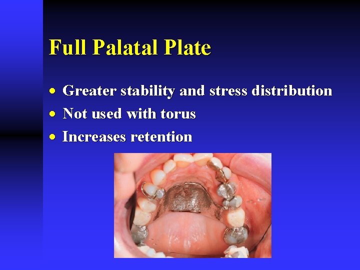 Full Palatal Plate · Greater stability and stress distribution · Not used with torus