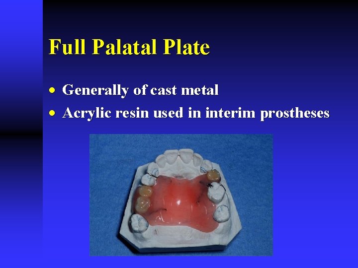 Full Palatal Plate · Generally of cast metal · Acrylic resin used in interim