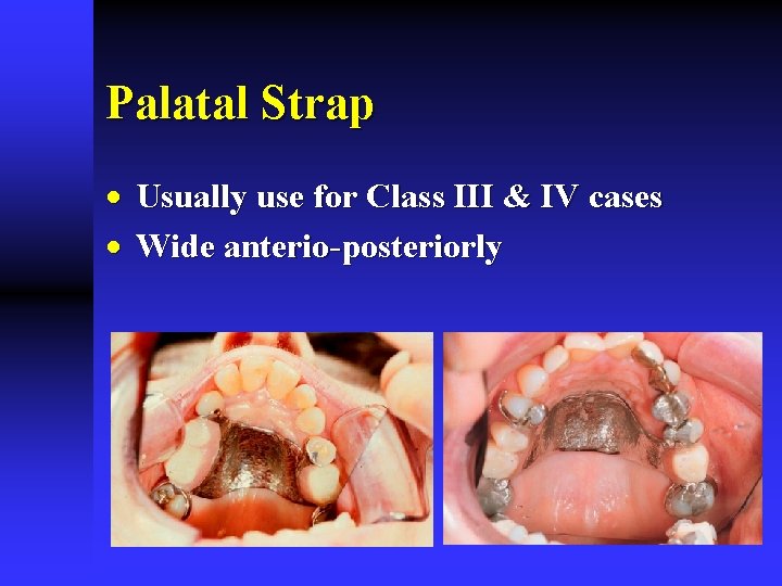 Palatal Strap · Usually use for Class III & IV cases · Wide anterio-posteriorly