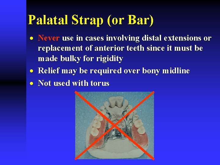 Palatal Strap (or Bar) · Never use in cases involving distal extensions or replacement