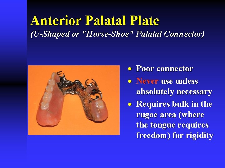 Anterior Palatal Plate (U-Shaped or "Horse-Shoe" Palatal Connector) · Poor connector · Never use