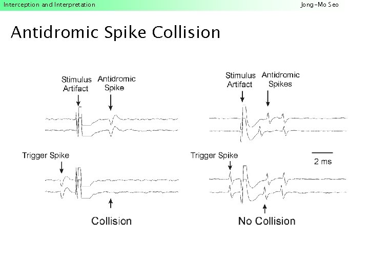 Interception and Interpretation Antidromic Spike Collision Jong-Mo Seo 