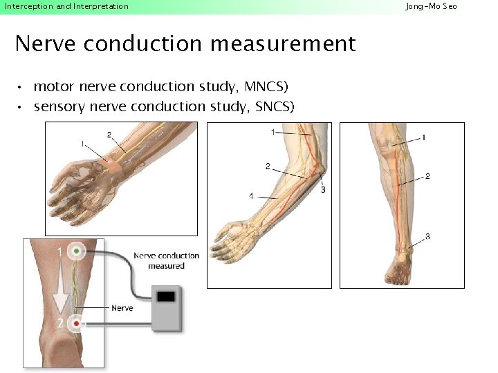 Interception and Interpretation Nerve conduction measurement • motor nerve conduction study, MNCS) • sensory