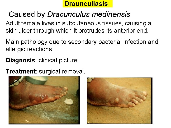 Draunculiasis Caused by Dracunculus medinensis Adult female lives in subcutaneous tissues, causing a skin Draunculiasis Caused by Dracunculus medinensis Adult female lives in subcutaneous tissues, causing a skin