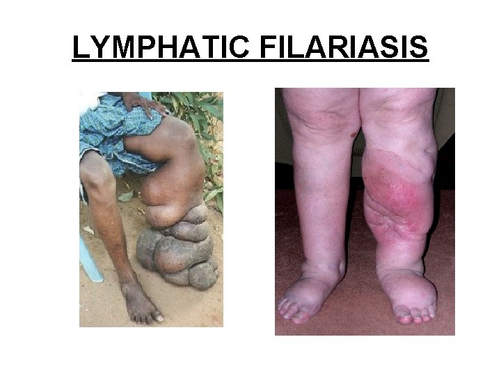 LYMPHATIC FILARIASIS LYMPHATIC FILARIASIS