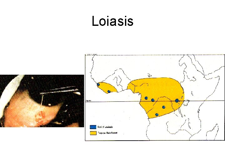 Loiasis Loiasis