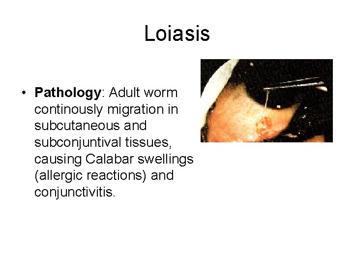 Loiasis • Pathology: Adult worm continously migration in subcutaneous and subconjuntival tissues, causing Calabar Loiasis • Pathology: Adult worm continously migration in subcutaneous and subconjuntival tissues, causing Calabar