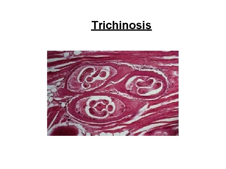 Trichinosis Trichinosis