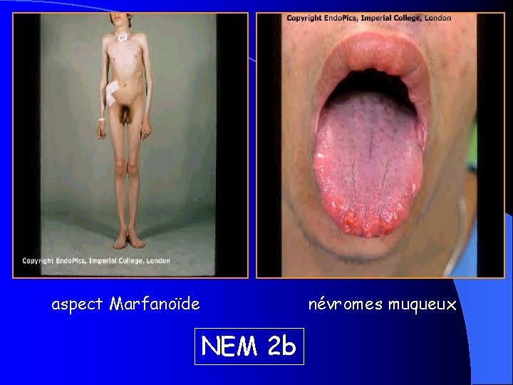 aspect Marfanoïde NEM 2 b névromes muqueux 